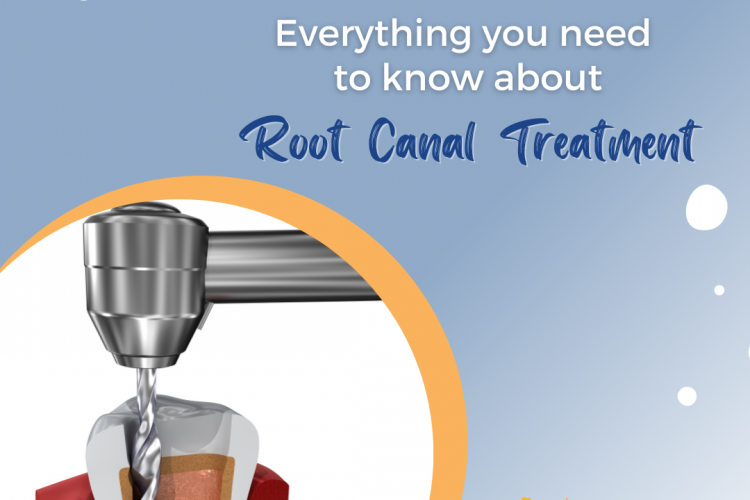 root canal treatment darwin