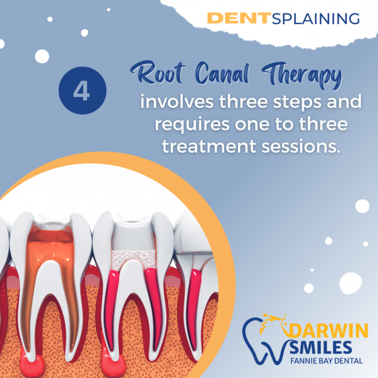 root canal therapy steps